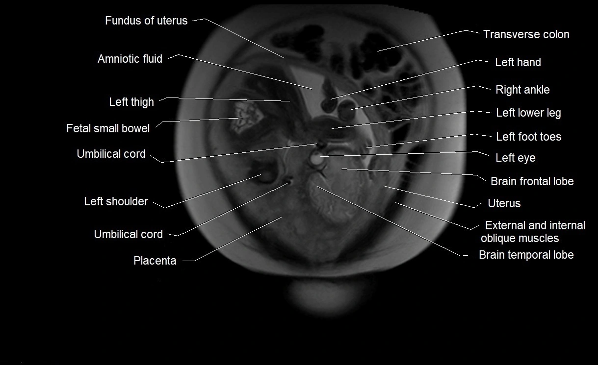 MRI Anatomy of pregnancy image 7.webp
